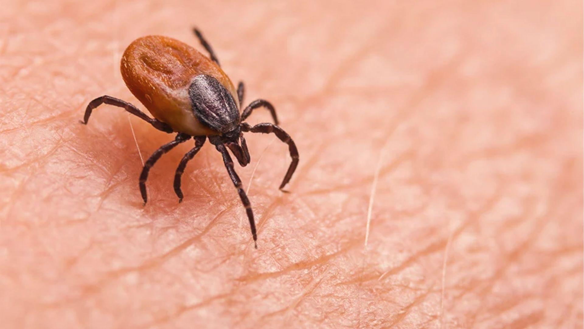 Deer tick embedded in human skin, known as Georgia carrier of Lyme disease and Rocky Mountain spotted fever.